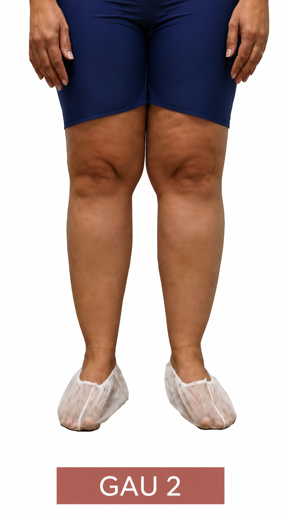 Ilustração clínica do lipedema Grau 2