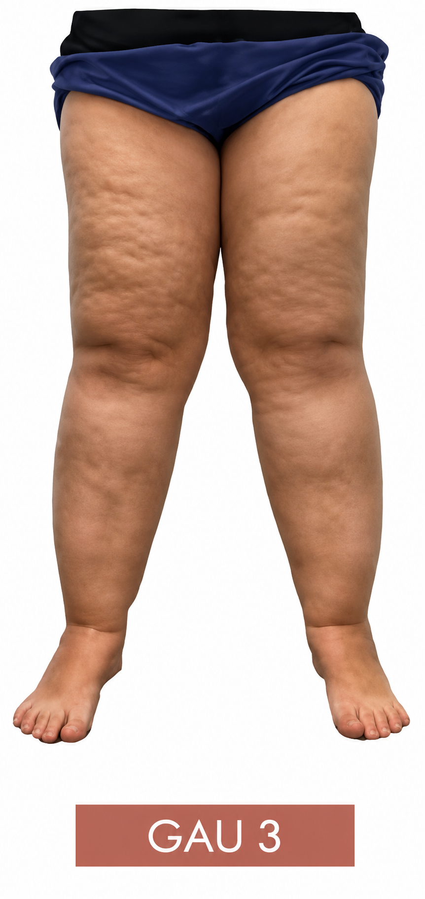 Ilustração clínica do lipedema Grau 3