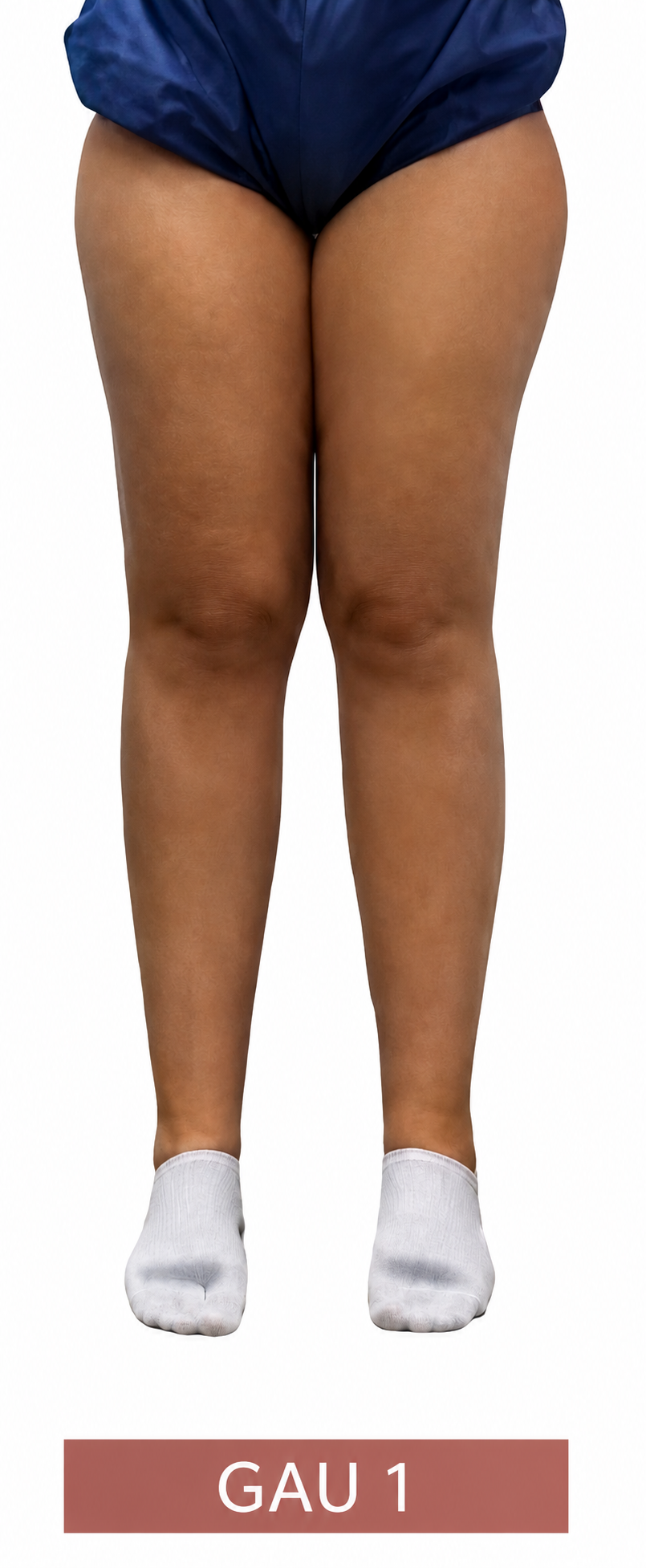 Ilustração clínica do lipedema Grau 1